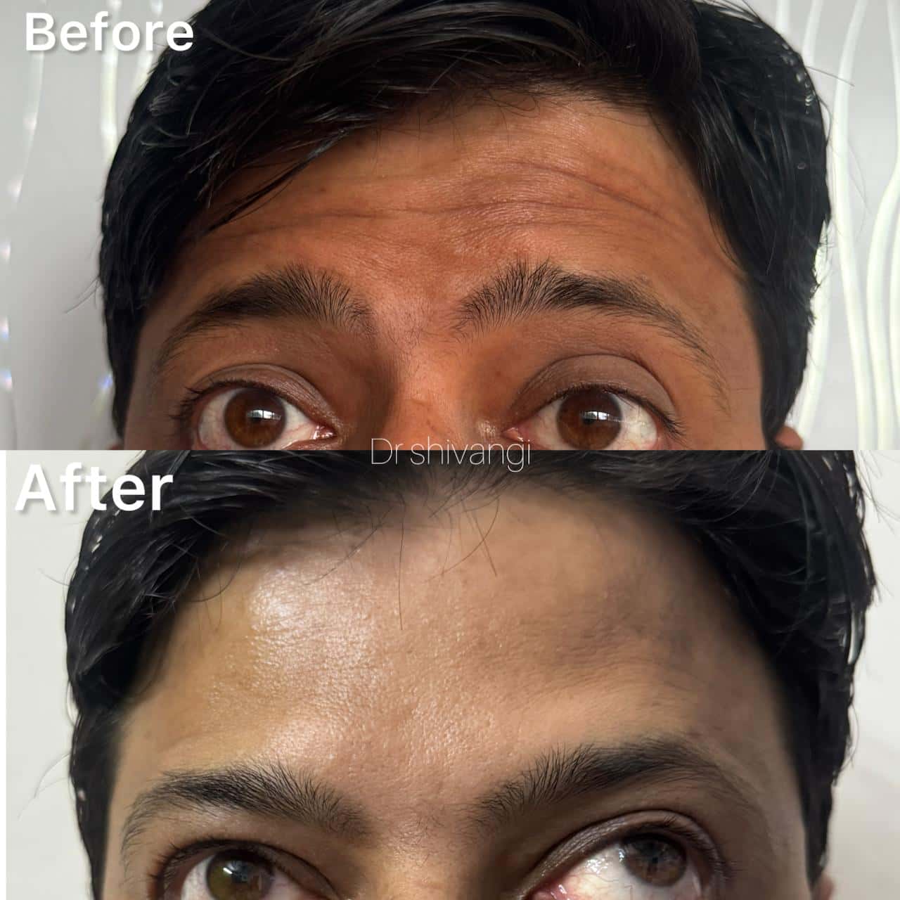 Botox Result 1