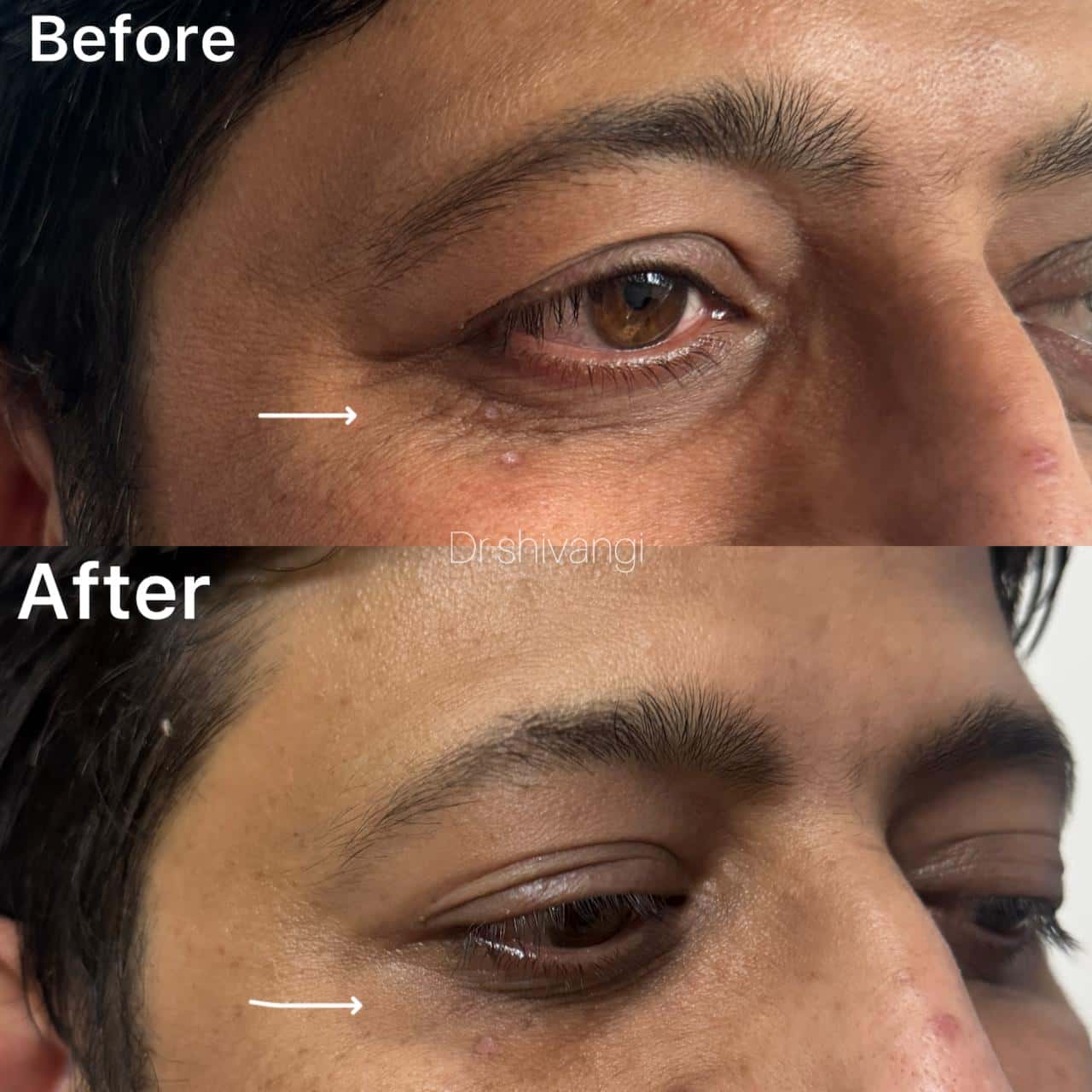 Botox Result 2