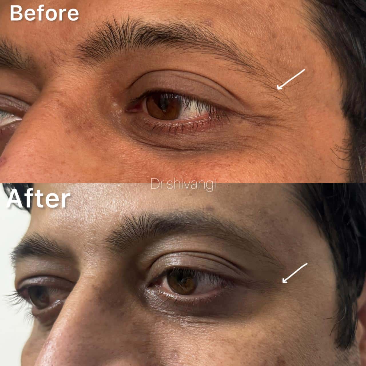 Botox Result 3