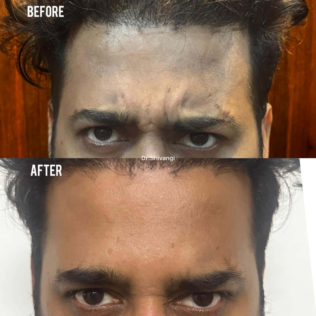 Botox Result 5