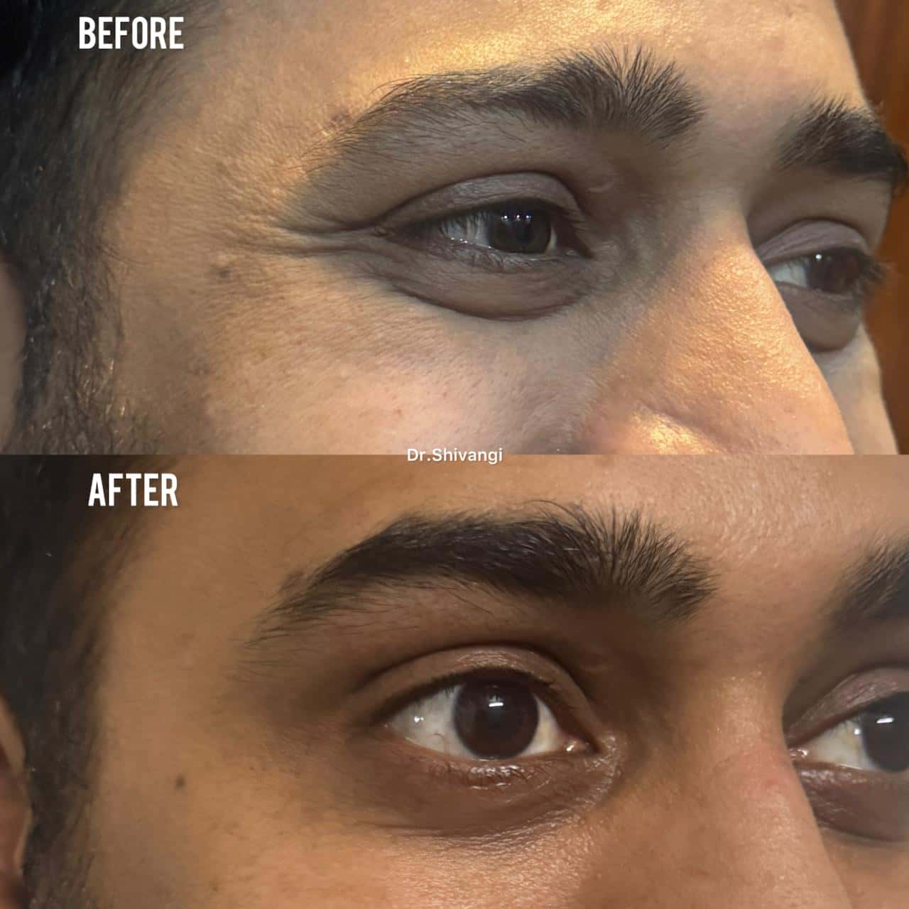 Botox Result 6