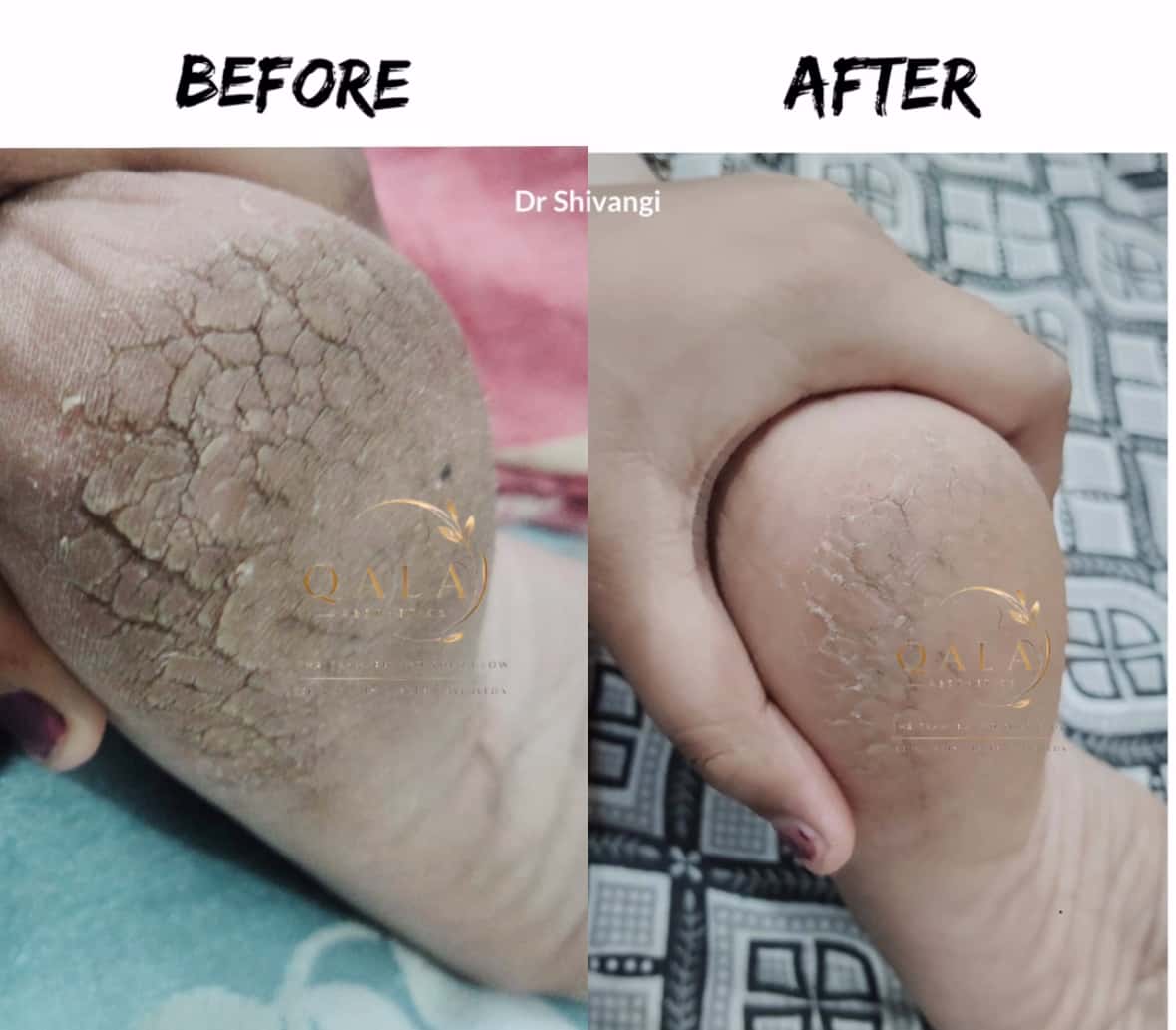 Skin Treatment Result