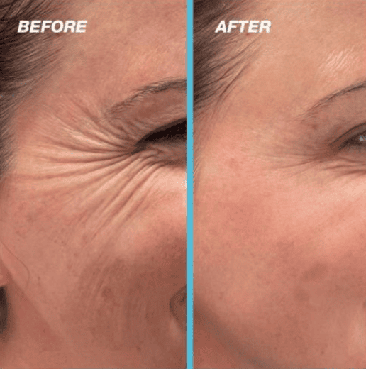 Botox Treatment